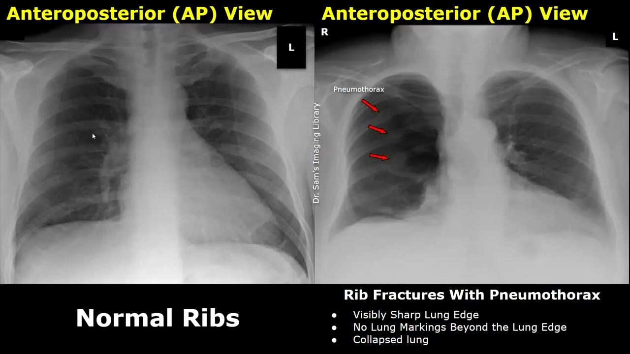 Chest X-Ray Ribs Normal Vs Abnormal Image Appearances | Fractures, Pneumothorax, Flail Chest CXR
