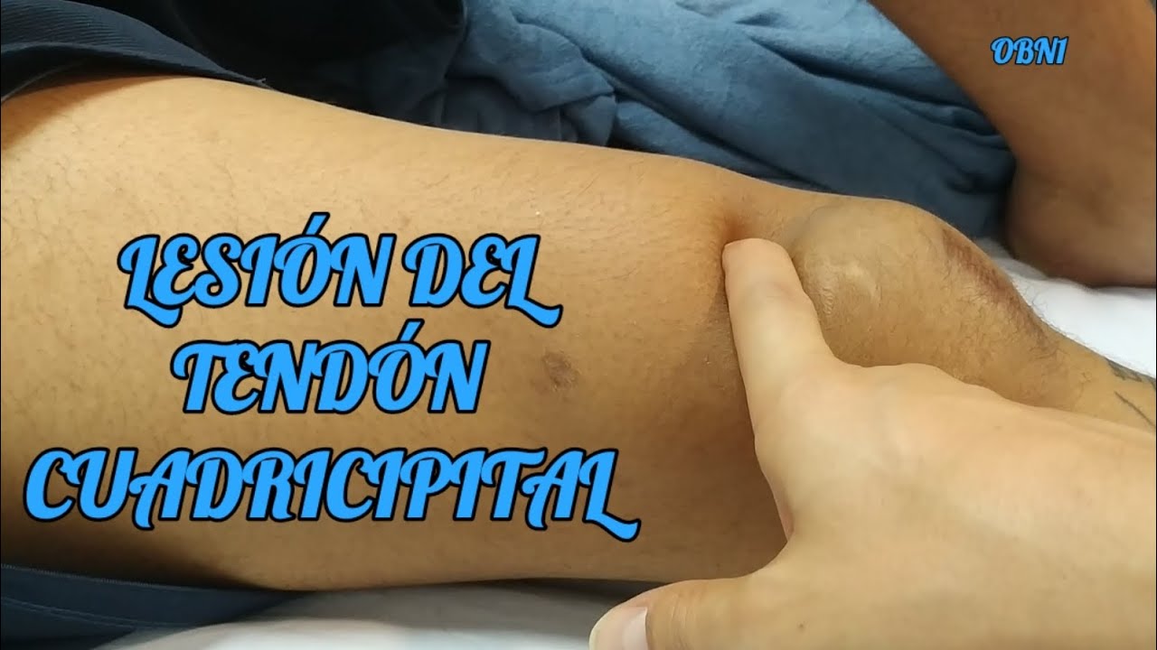 TENDÓN CUADRICIPITAL ROTO - LESIÓN DEL MECANISMO EXTENSOR DE LA RODILLA