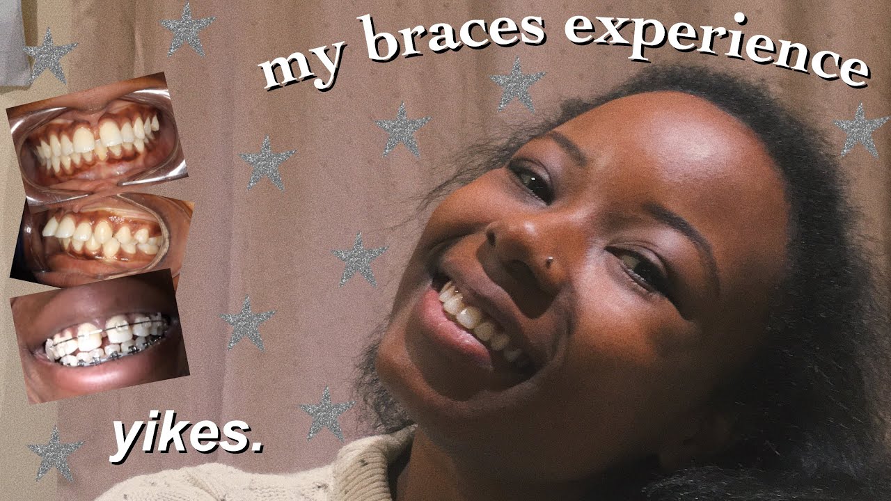 my braces experience! why i got them, the process, was it worth the £££? *before and after pics*