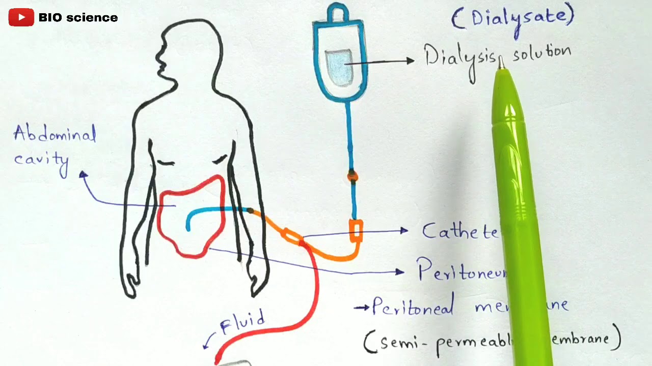 Types of dialysis | Intermittent dialysis | Peritoneal dialysis | Continuous renal replacement