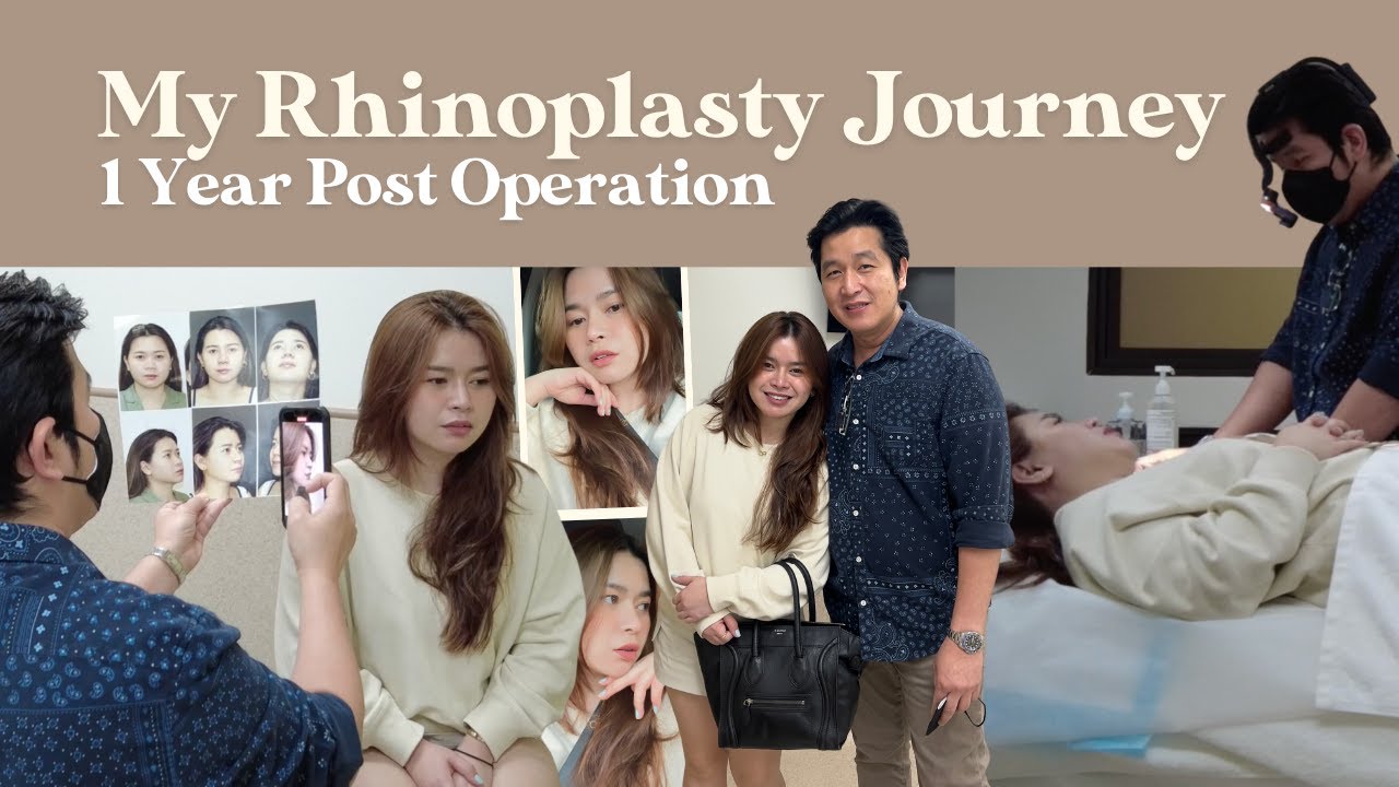 My Rhinoplasty Journey (Part 4): 1 Year Post Operation