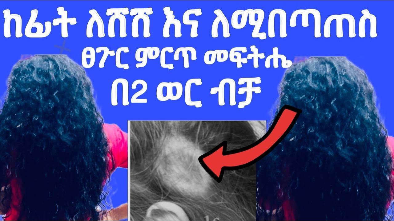 ለሚበጣጠስ እና ከፊት ለገባ ፀገር ምርጥ መፍትሔ በሁለት ወር ዉስጥ ብቻ ያገኘሁት ለዉጥ👌