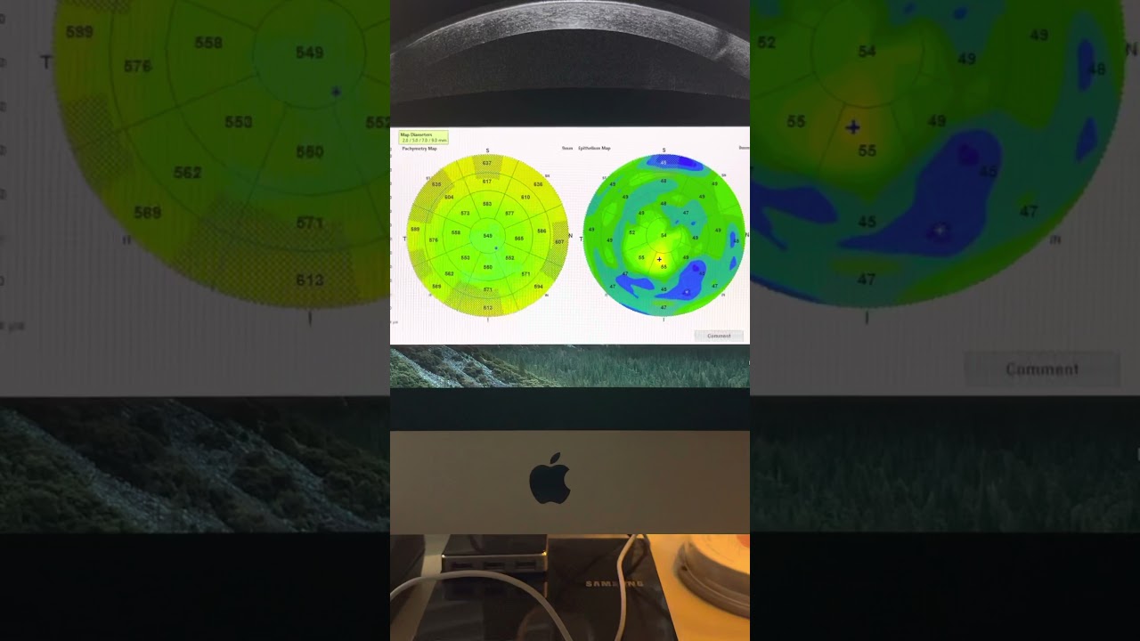 Correcting the IOP goal in glaucoma by correlating ONH OCT data to funduscopy: Kanellopoulos, MD