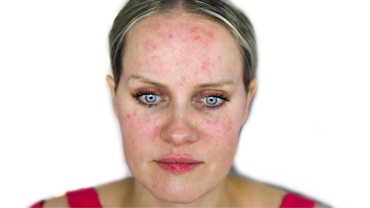 CURING MY ROSACEA - How I Plan to Do It