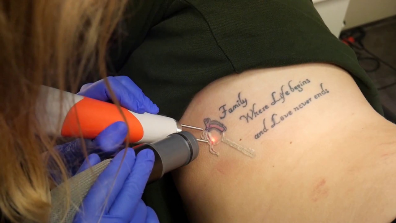 Tattoo verwijdering bij Tattoo Bob