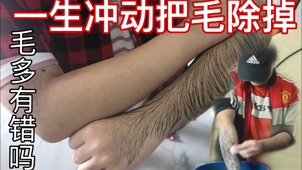 多毛人苦诉一生坎坷经历 忍痛把爱毛去除