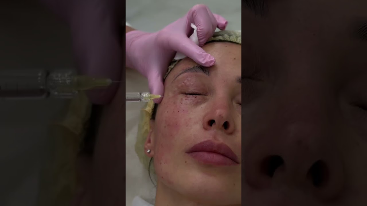 На видео наш врач Эльмира Азгамовна продемонстрировала, как проходит процедура биорепарации Plinest.