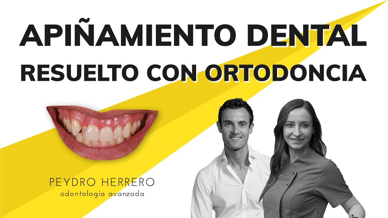 Invisalign con el API&Ntilde;AMIENTO dental. Cl&iacute;nica Peydro Herrero, odontolog&iacute;a avanzada