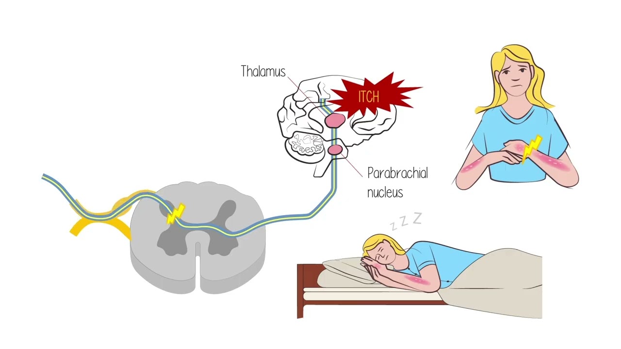 Itch Signaling and Neuroimmune Crosstalk