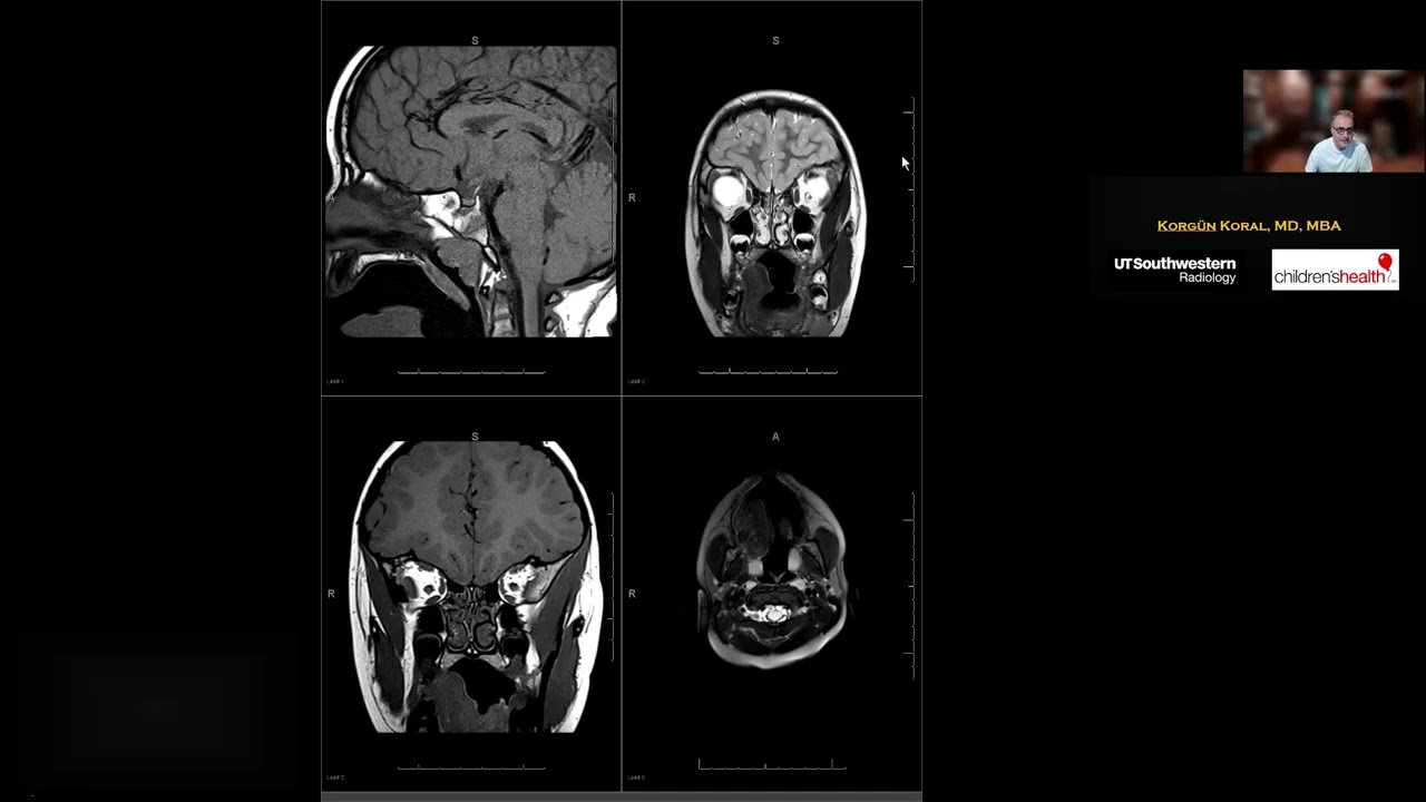 Normal ve Ektopik Posterior Pitüiter