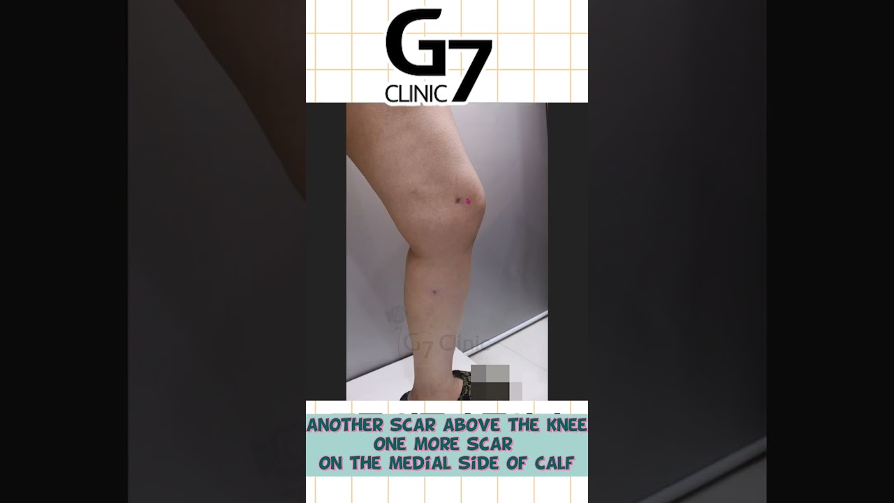 Must know before calf liposuction (Importance of scars!!!)