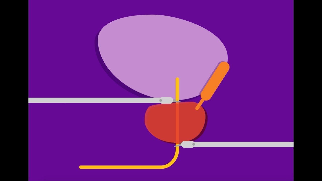 Robotic prostatectomy