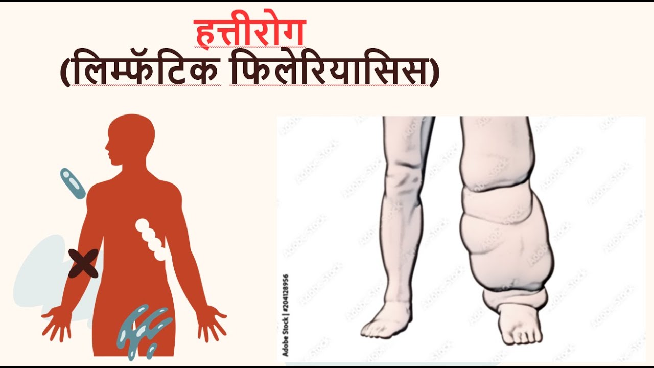Elephantiasis (Lymphatic filariasis) | हत्तीरोग