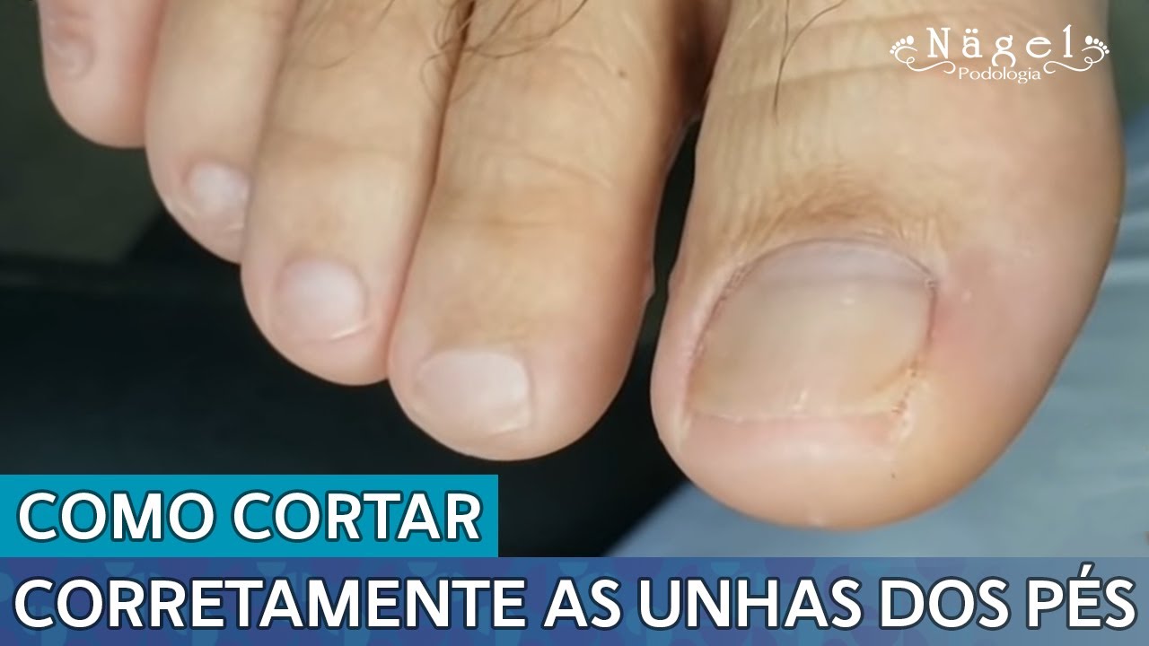 COMO CORTAR CORRETAMENTE AS UNHAS DOS PÉS
