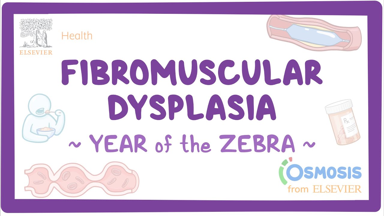 Fibromuscular dysplasia (Year of the Zebra)