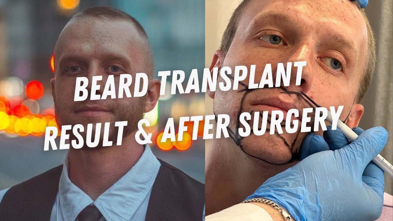 Beard Transplant Result | Beard Transplant Before and After 