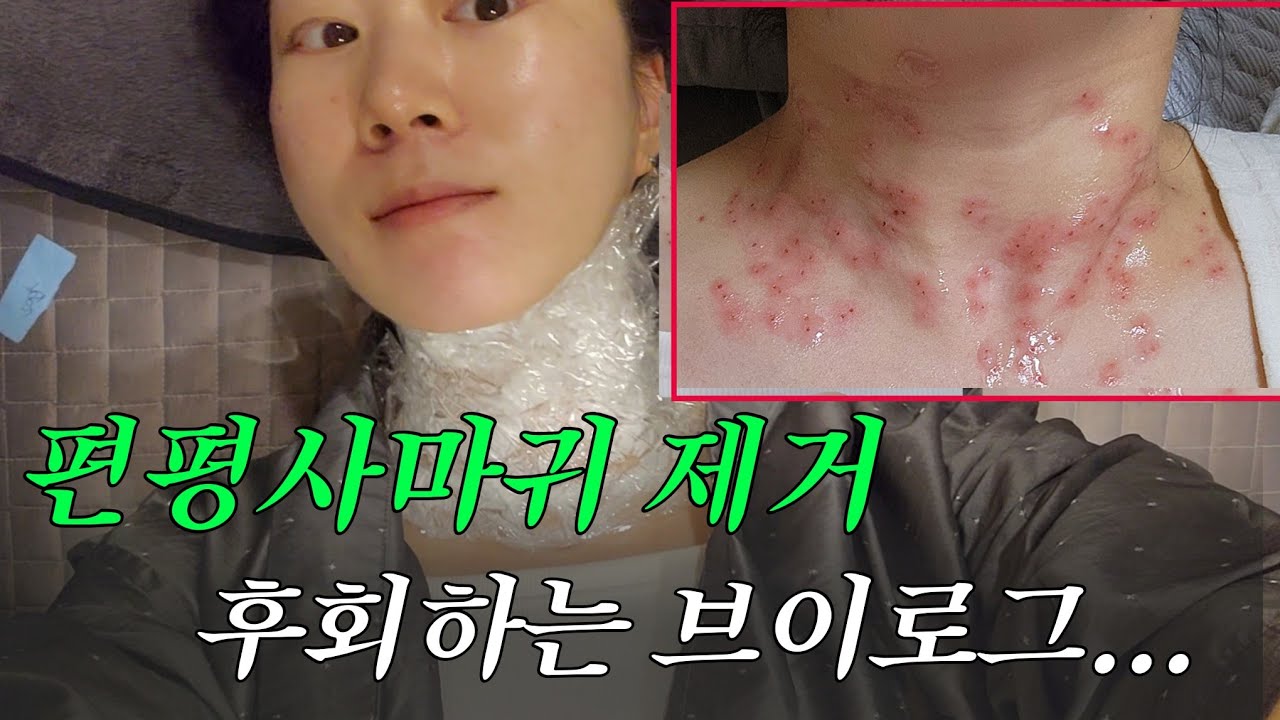 [VLOG]편평사마귀 제거 브이로그 | 시술 후 관리 솔직후기 재생크림 추천까지