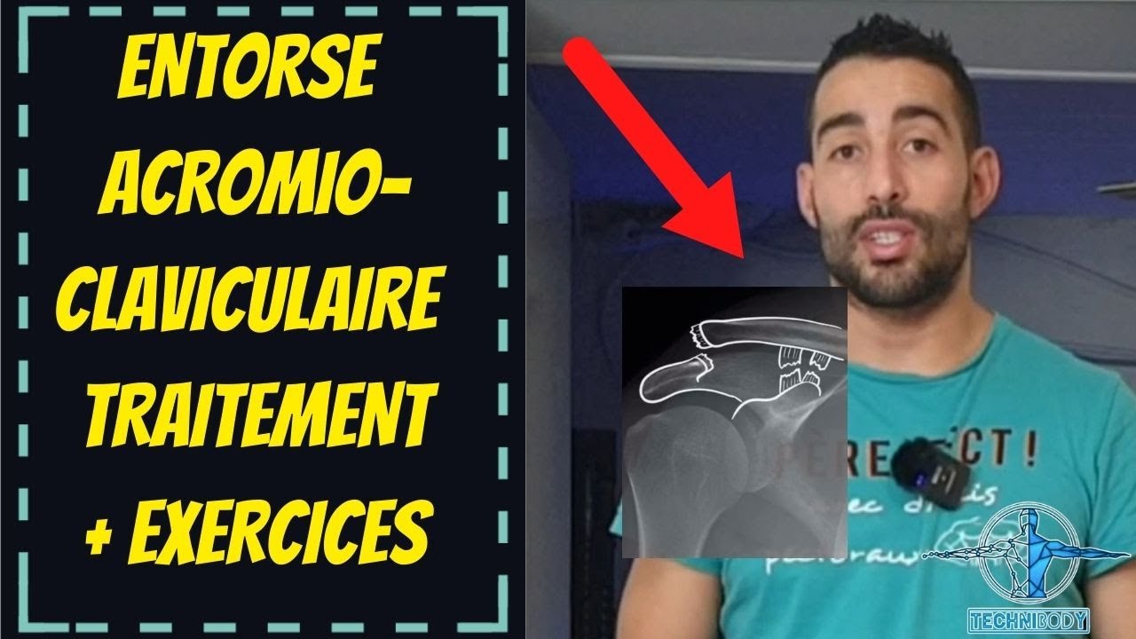 Luxation  ( entorse ) acromio claviculaire - rééducation et chirurgie