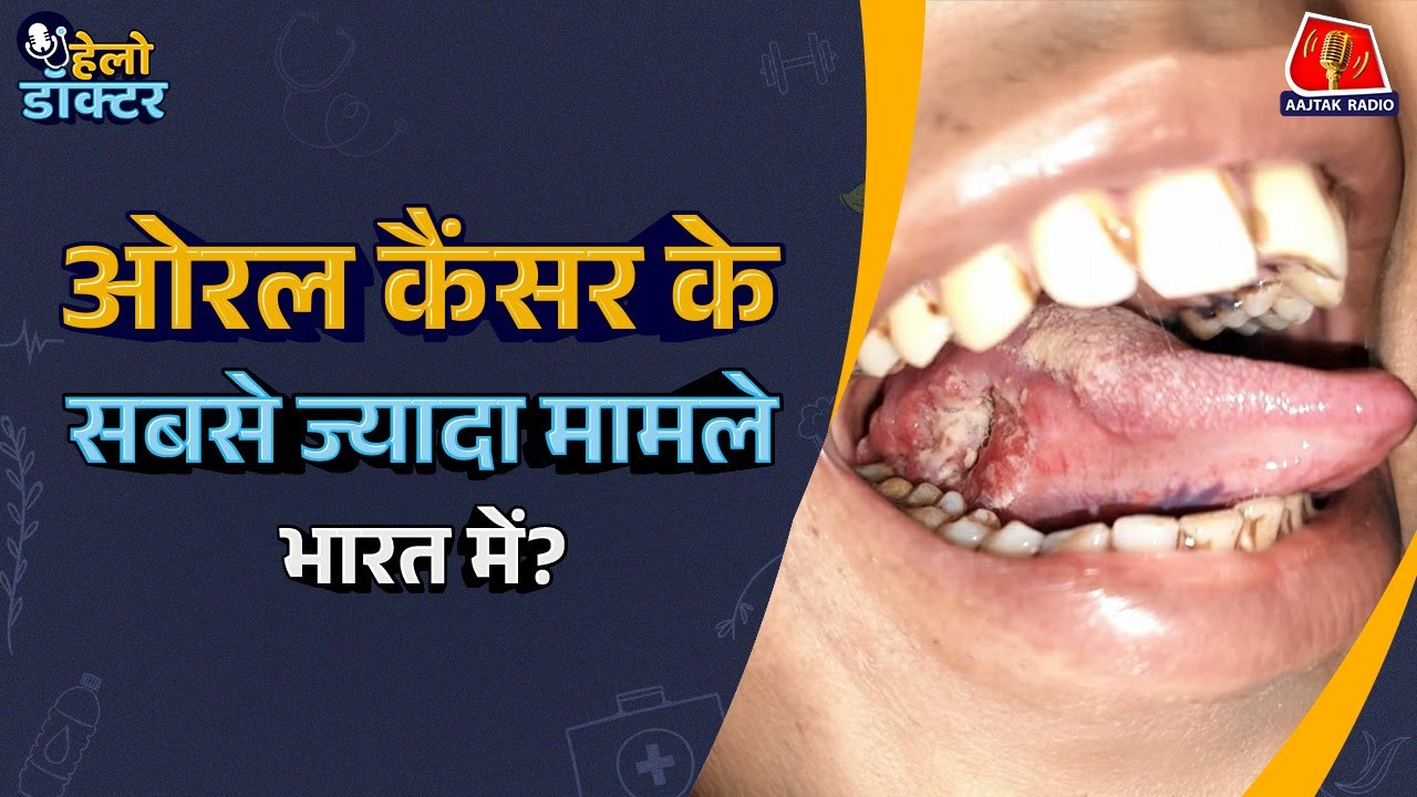Cigarette और Alcohol पिए बिना कैसे हो जाता है Mouth Cancer?: Hello Doctor