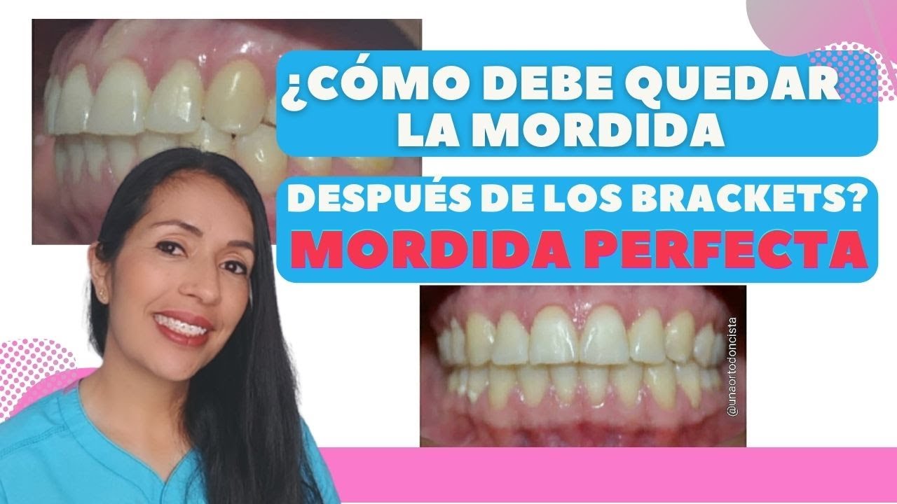 ¿Cómo debe quedar la mordida despues de los brackets?.  Mordida perfecta