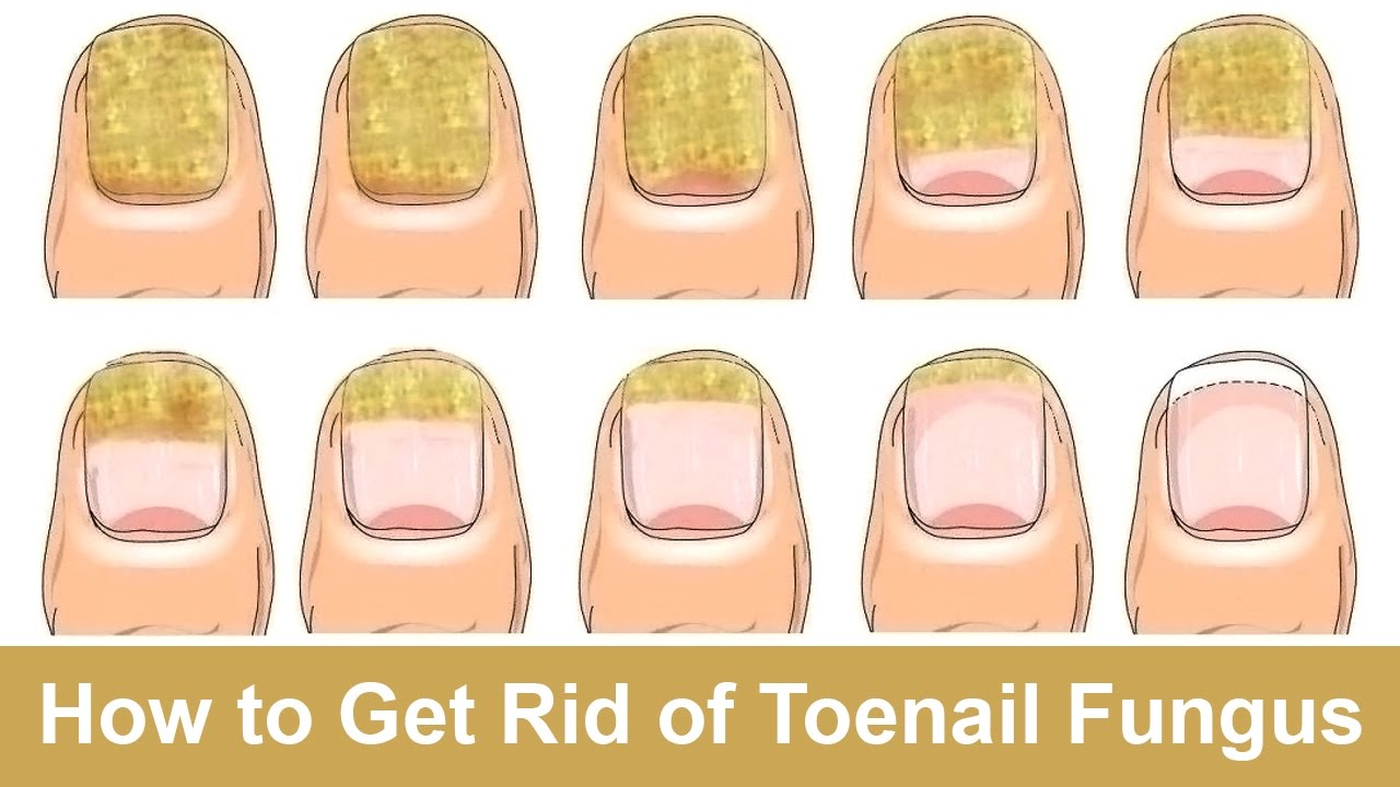 How to Get Rid of Toenail Fungus Fast and Naturally