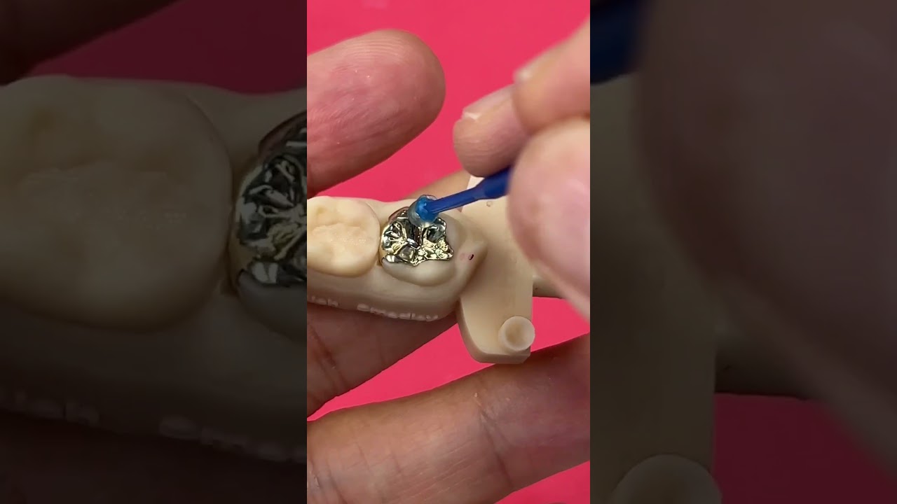 Gold Posterior Inlay/Onlay 