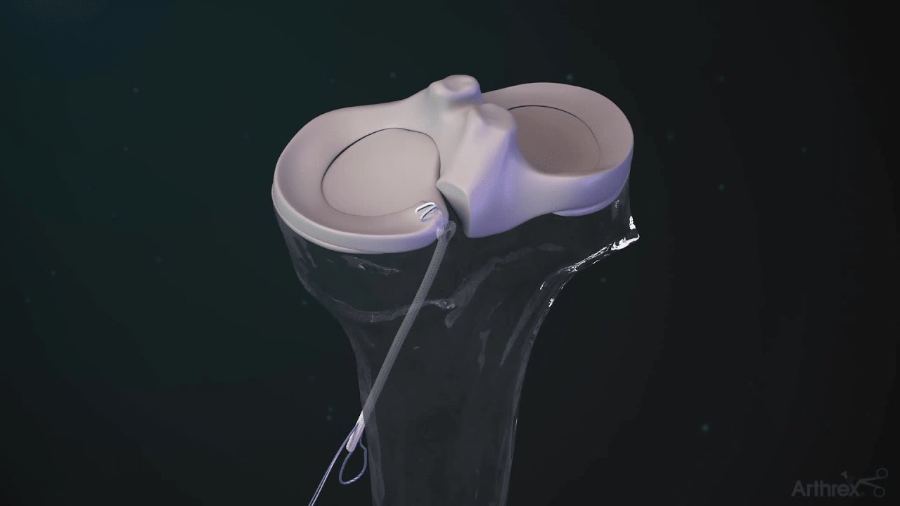 SutureLoc&trade; Implant for Meniscal Root Repair