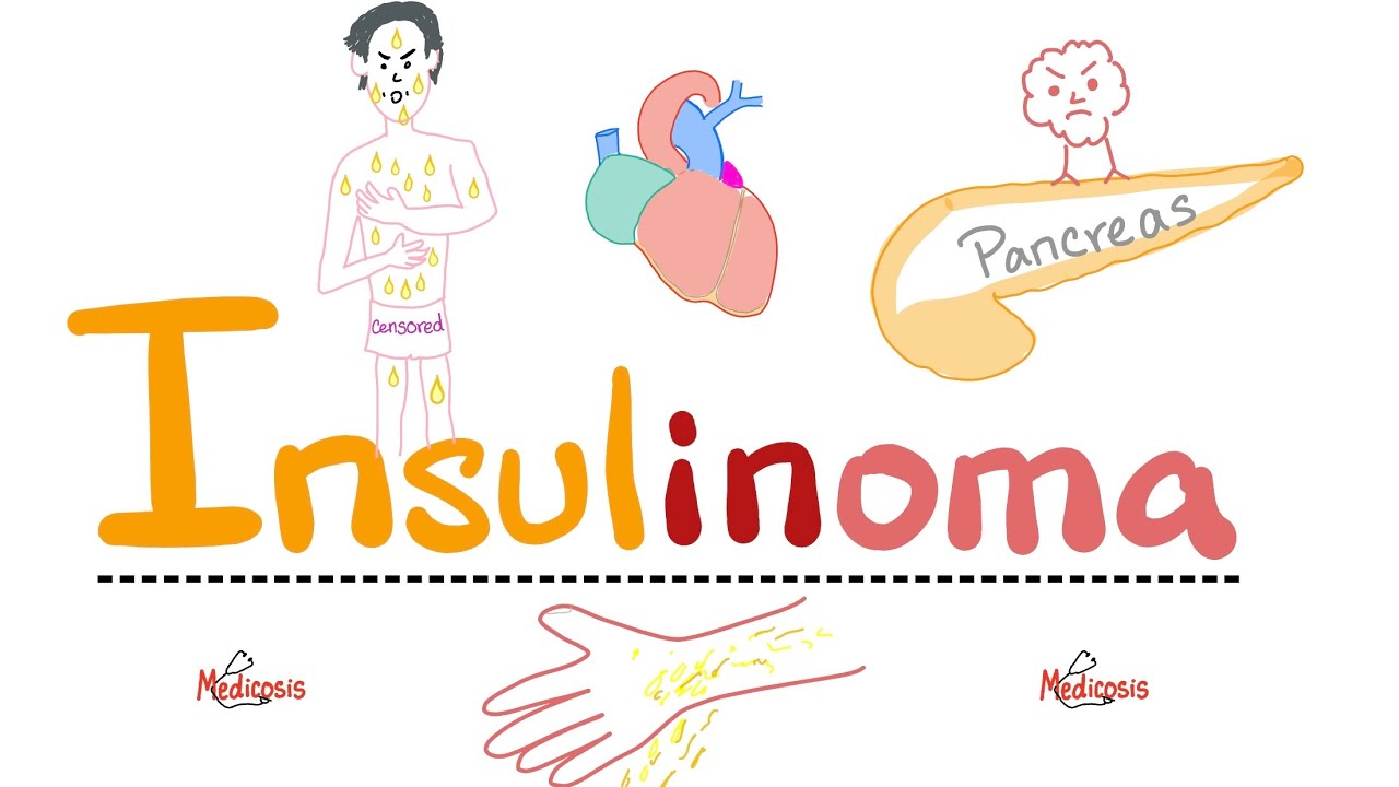 Insulinoma -  Insulin-secreting tumor -  Endocrine Pathology - Clinical Biochemistry