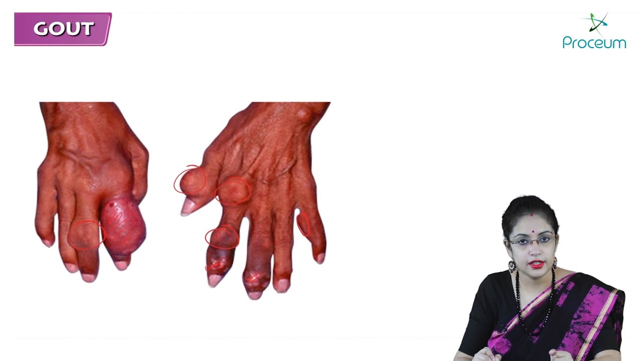 Gout (Hindi) - Causes, Symptoms, Diagnosis, and Treatment | Internal Medicine