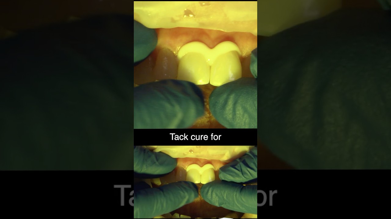 SEATING Zirconia Crowns on the ANTERIOR #dental