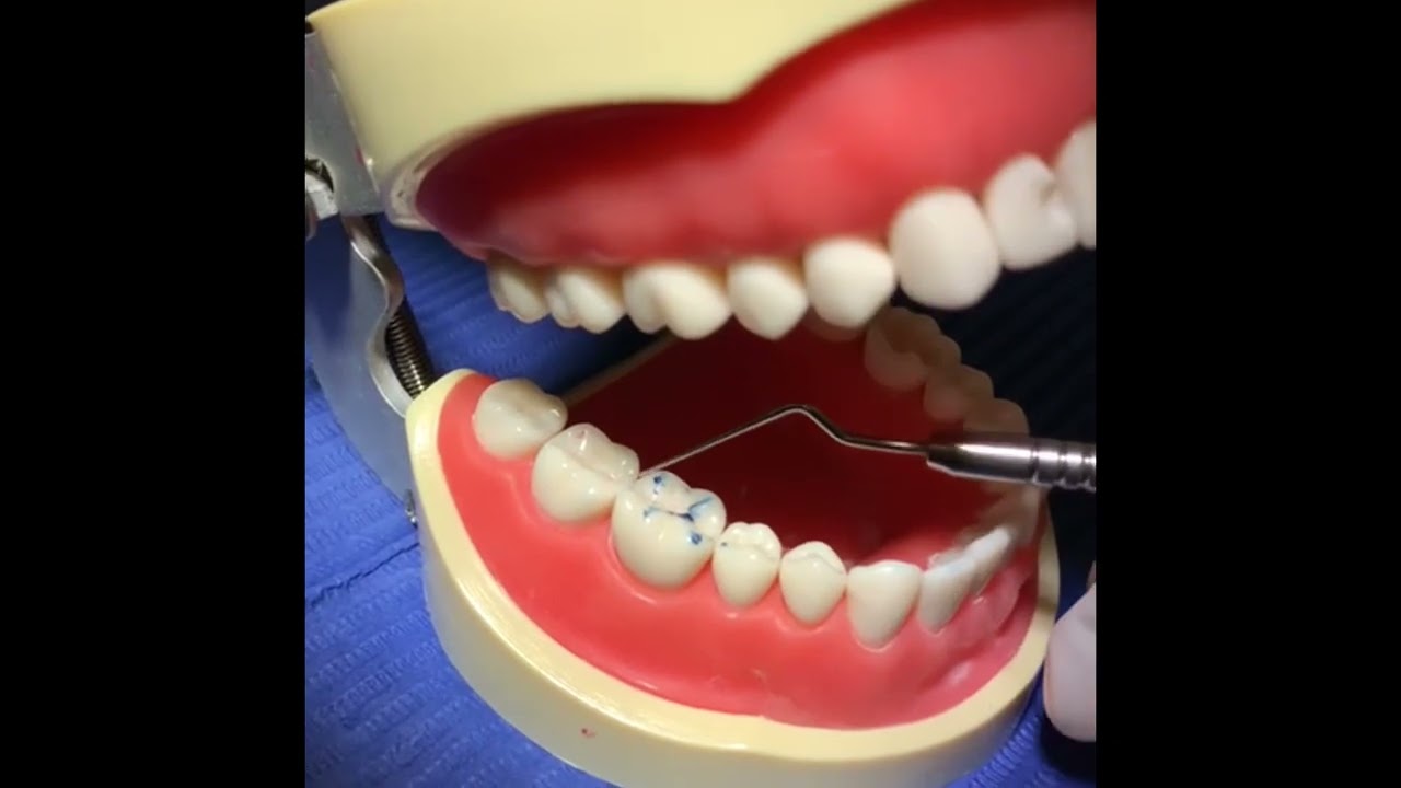 Ajuste oclusal en resina- Cursó de Restauración “Universidad científica del sur”