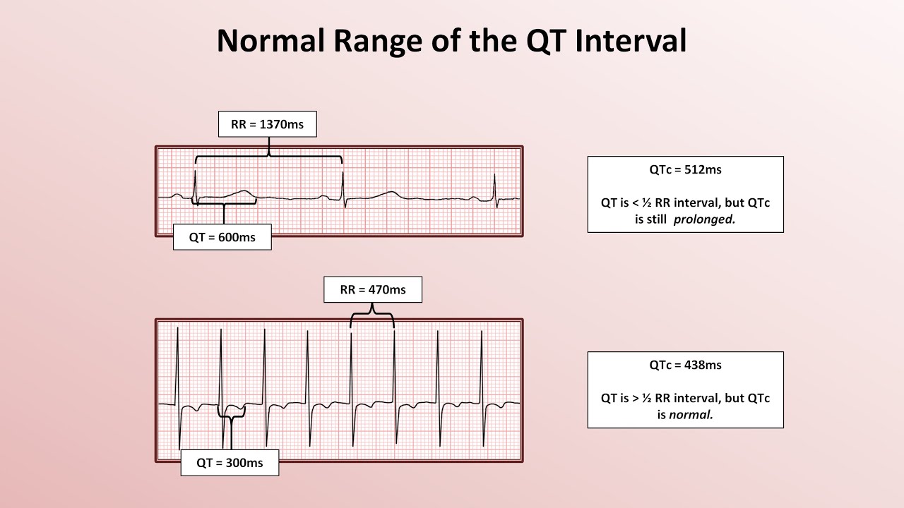 Advanced EKGs - The QT Interval and Long QT Syndrome