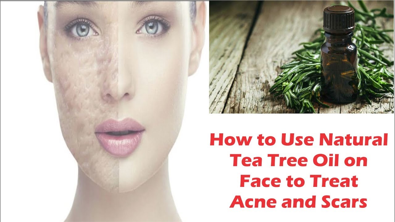 How to Use Natural Tea Tree Oil on Face to Treat Acne and Scars