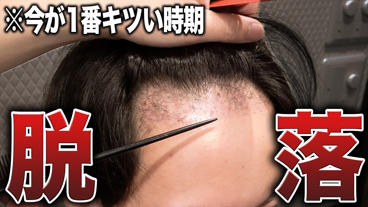 【植毛2ヶ月経過】おでこを狭くした30代男性が明かす不安との葛藤