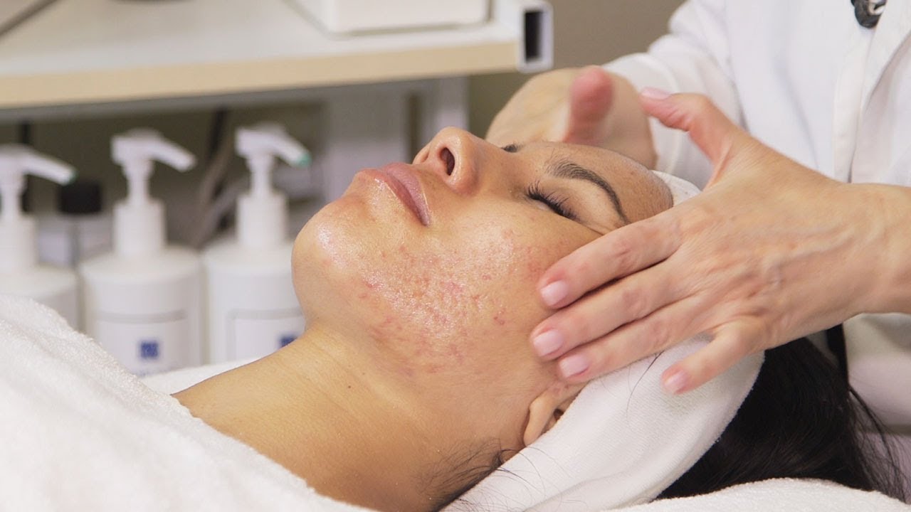 3 Facials Later, Daniella's Hormonal Acne & Skin Care NOW