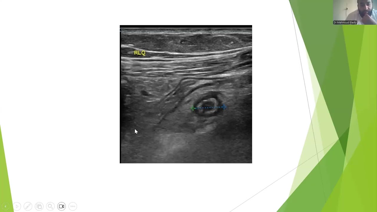 Bowel ultrasound