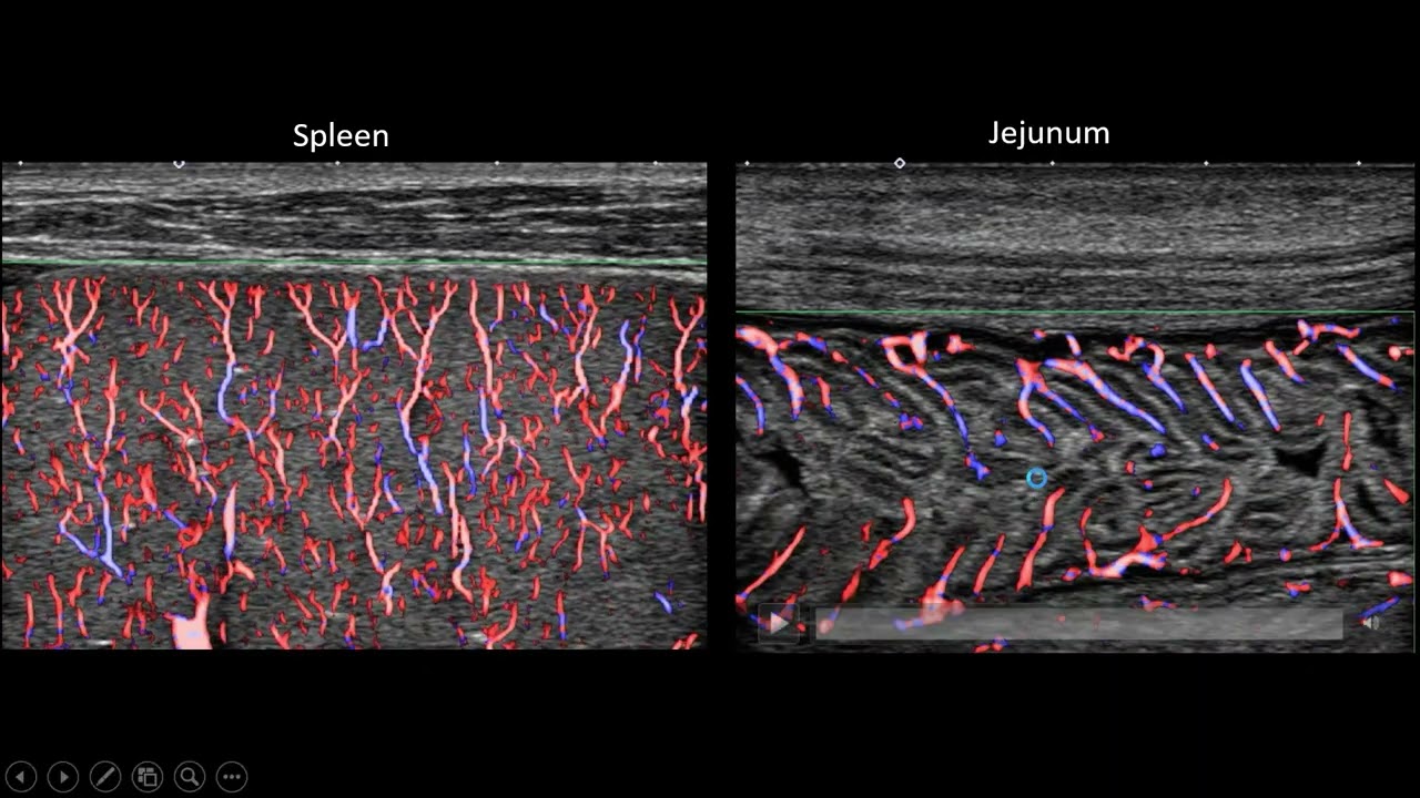 Do we really need Microvascular flow imaging? (SMI Angio mode)
