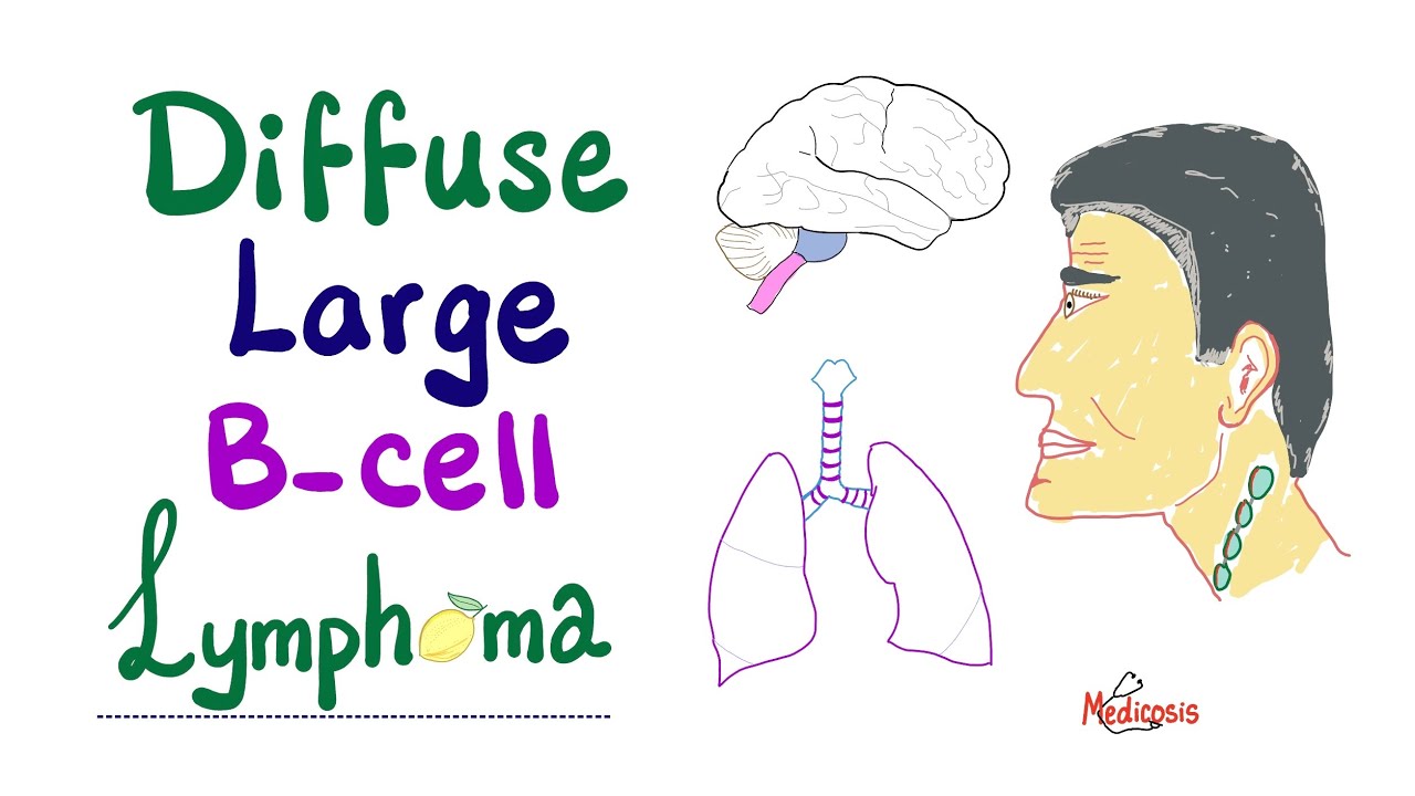 Diffuse Large B-Cell Lymphoma (DLBCL) - Aggressive  B-Cell Neoplasm - Non-Hodgkin’s Lymphoma