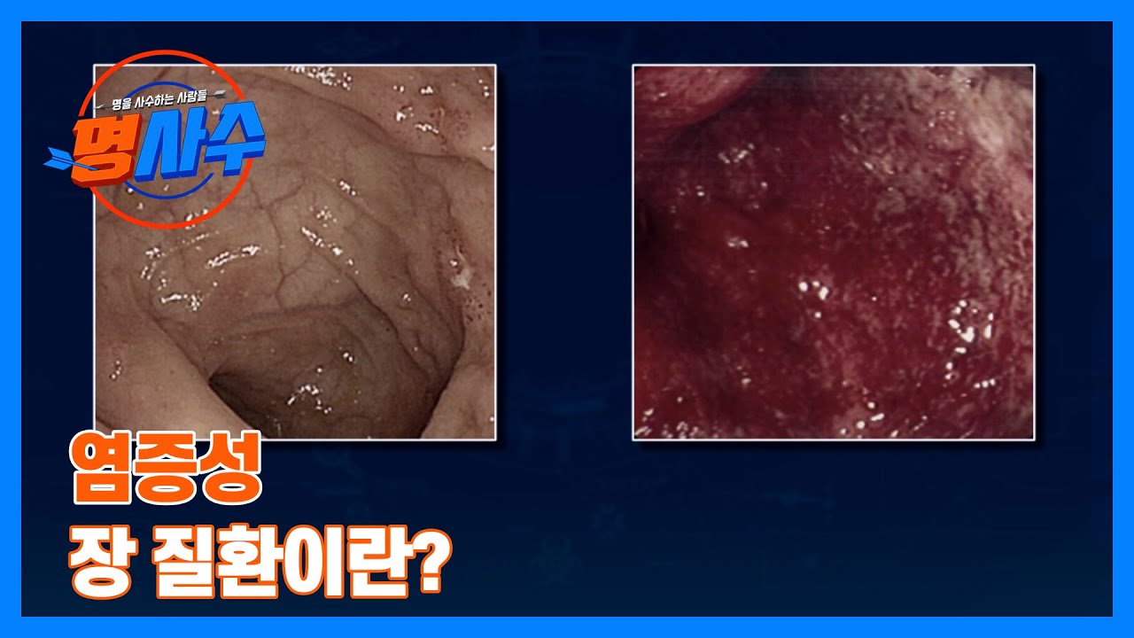 툭하면 피가 난다&hellip;? 염증성 장 질환이란? MBN 230802 방송