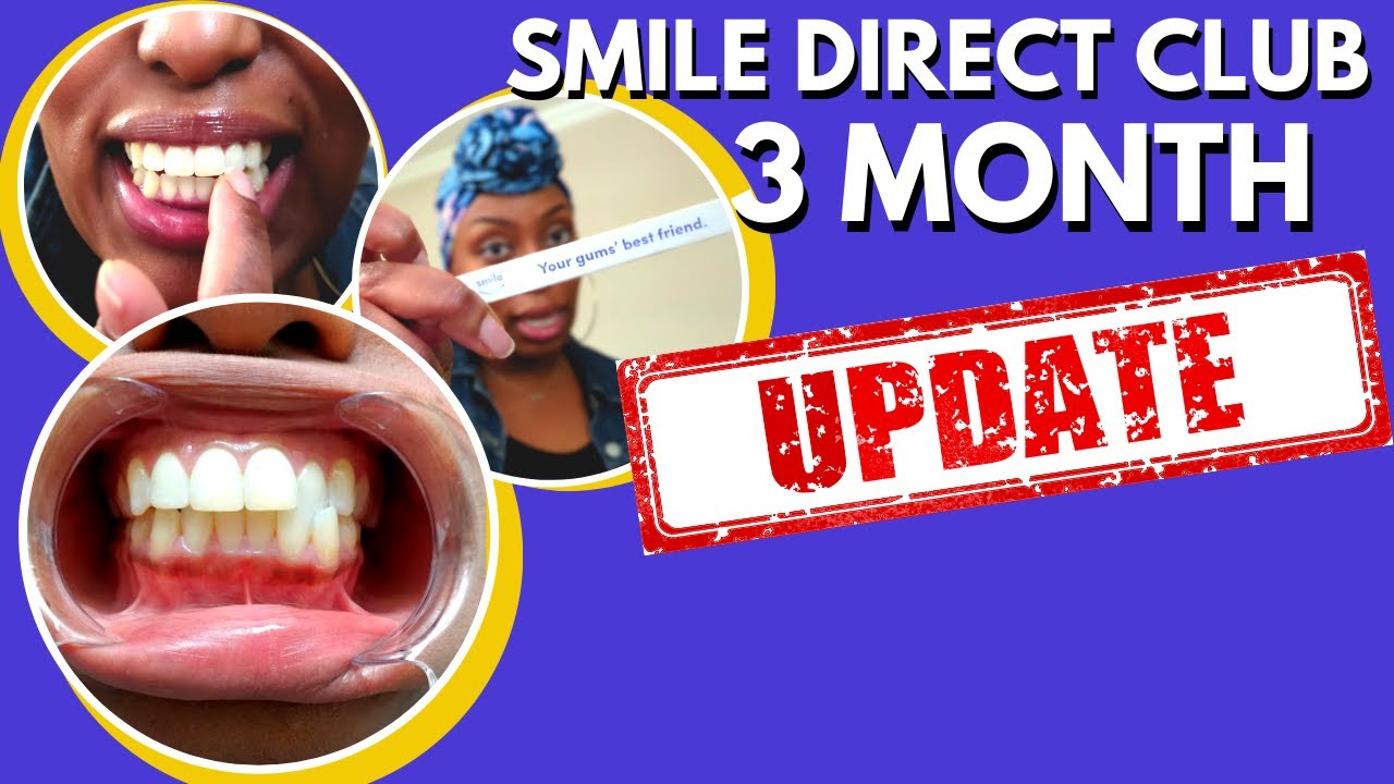 SMILE DIRECT CLUB 3 MONTH UPDATE | FAQ