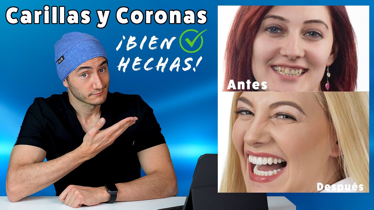 Así se ven las CARILLAS DENTALES BIEN HECHAS | Dentista Reacciona a casos de éxito