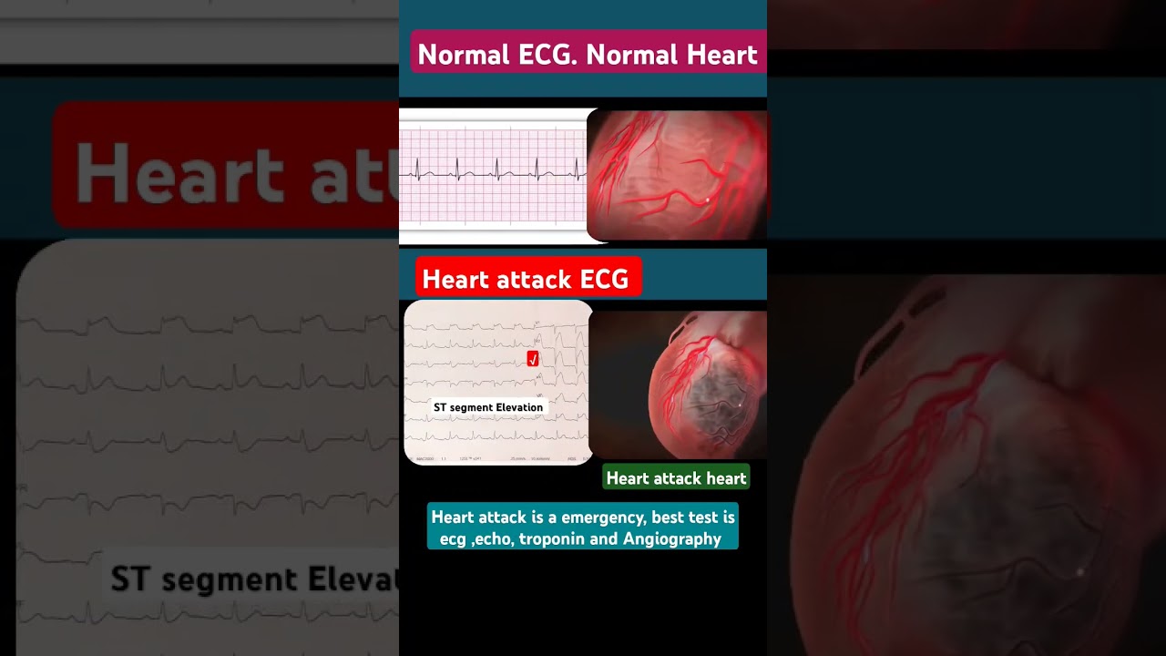 first test for heart attack l हार्ट अटैक के लिए टेस्ट l #ecg #echo #angiography #shorts