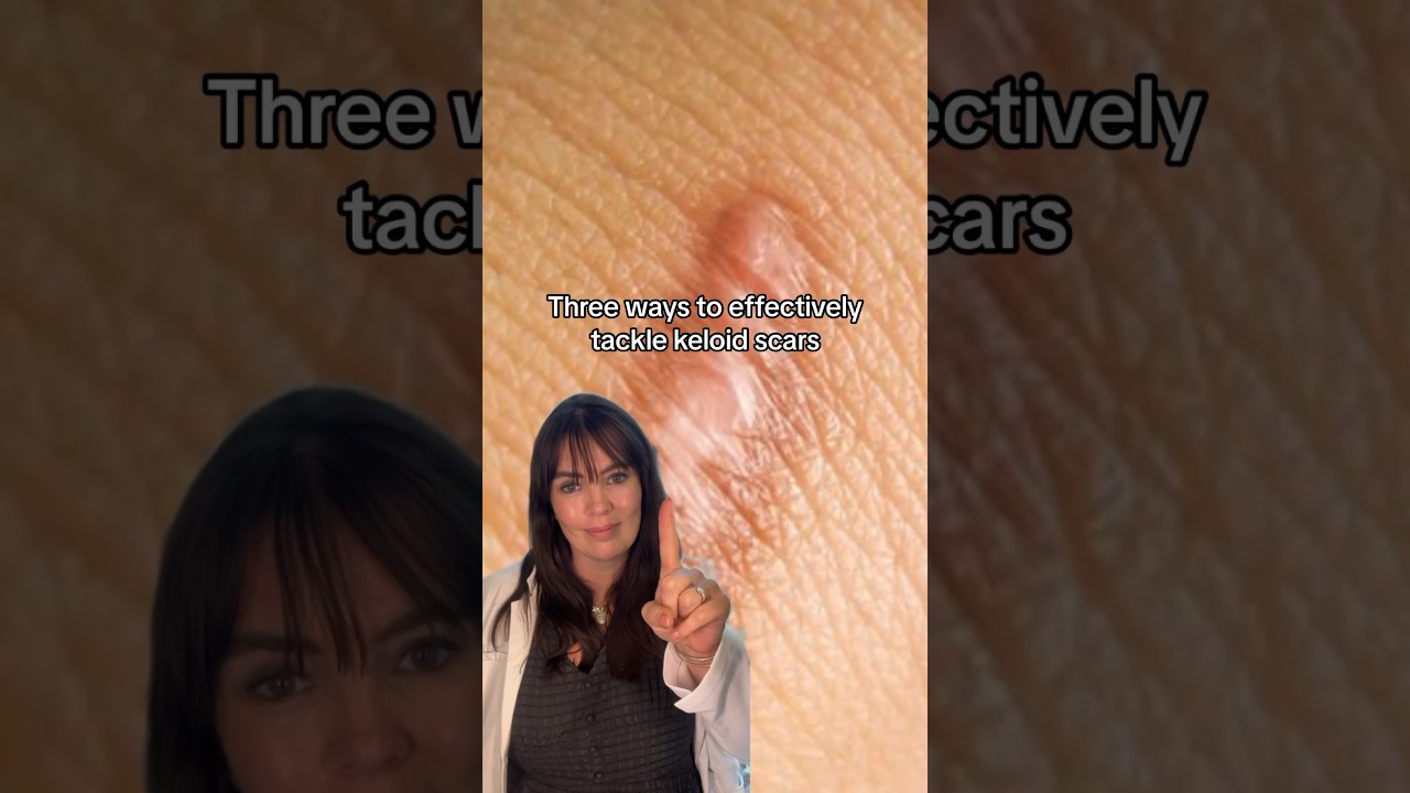 How to get rid of keloid scars non-surgically👆🏽 #keloid #keloidtreatment #scarremoval #scarring