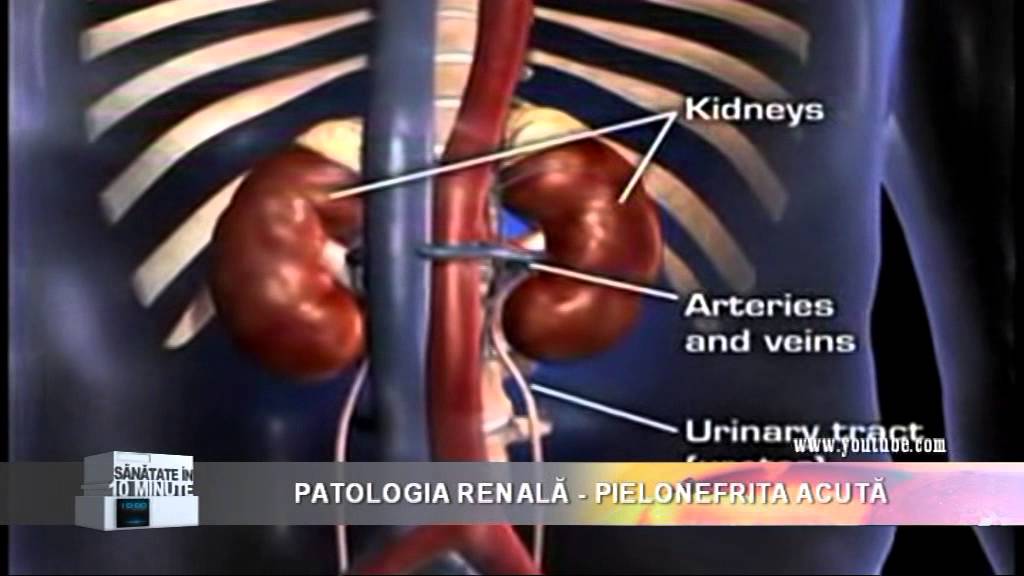 Patologia renala - Pielonefrita acuta