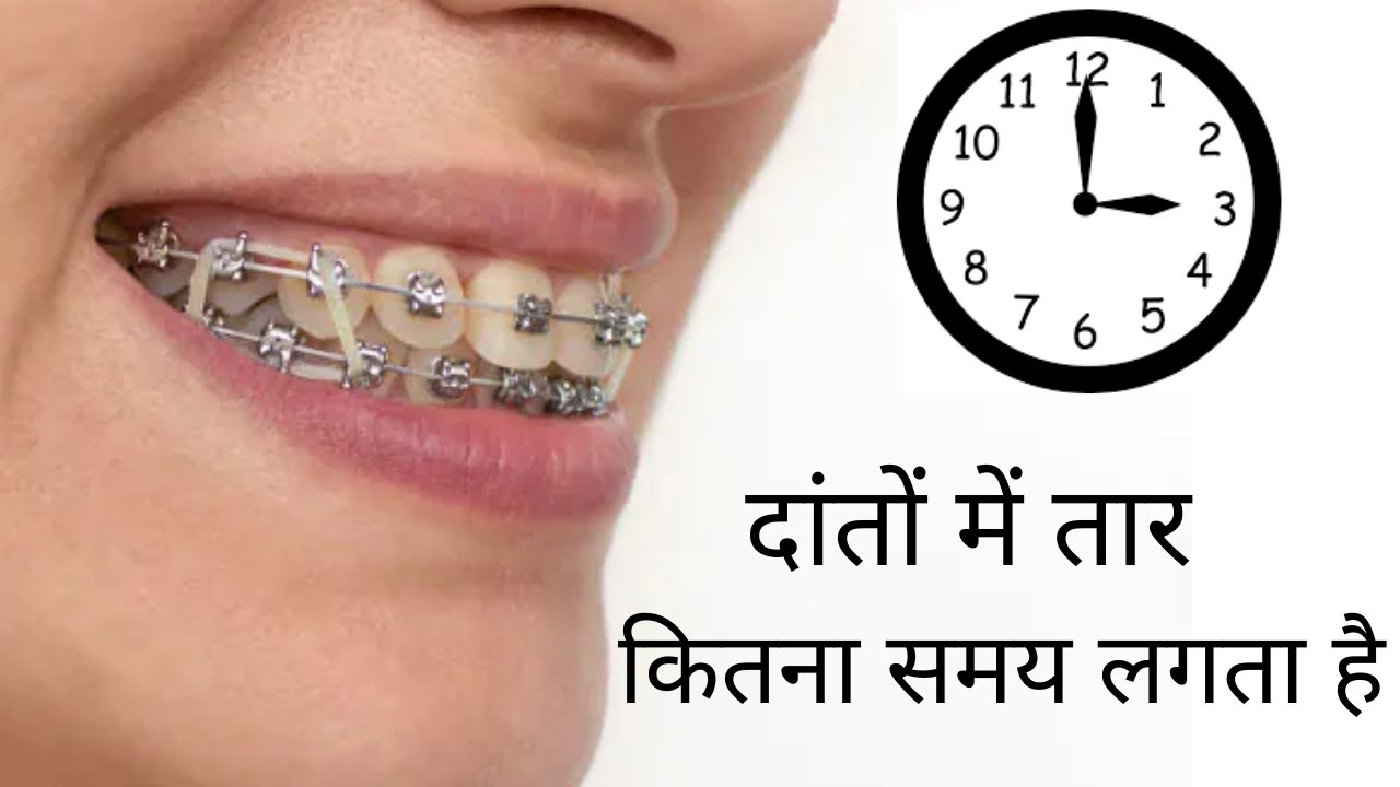 दांतों को अंदर करने में कितना समय लगता है, How long do braces take for Gap/ crowded/ Outward teeth