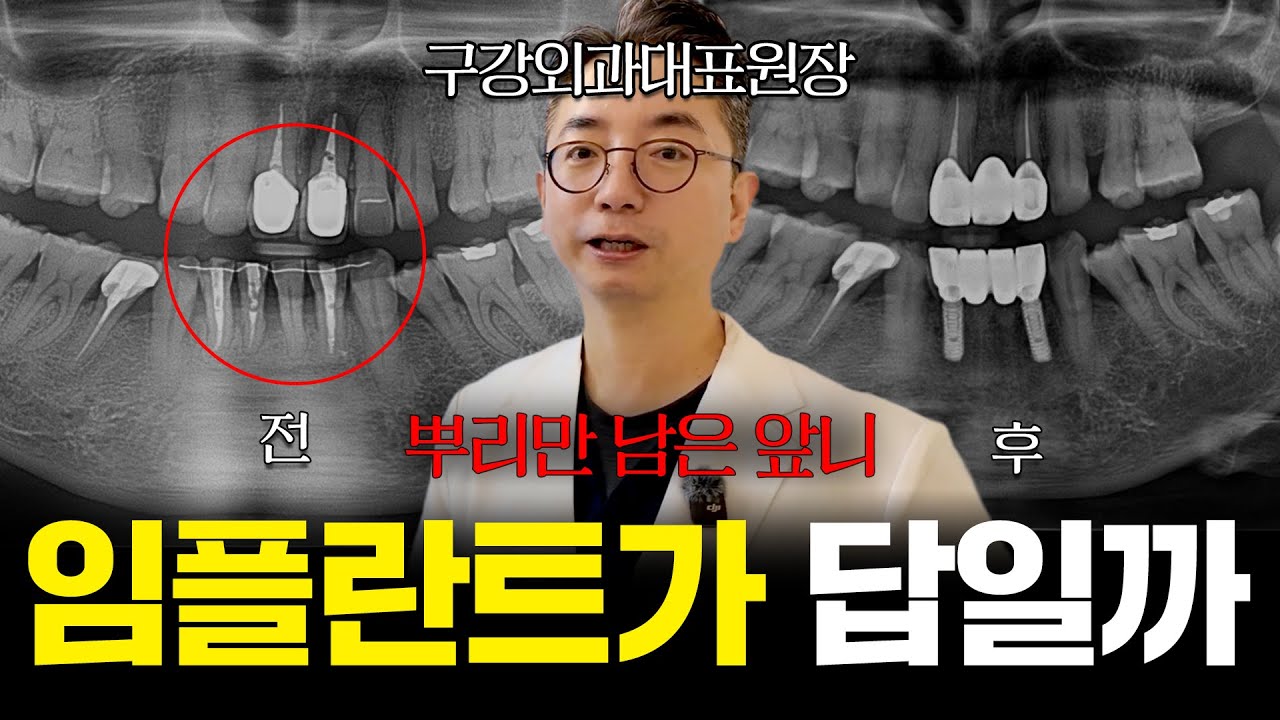 앞니 임플란트, 무조건 정답일까요? 뿌리만 남은 앞니에 브릿지가 더 나은 이유