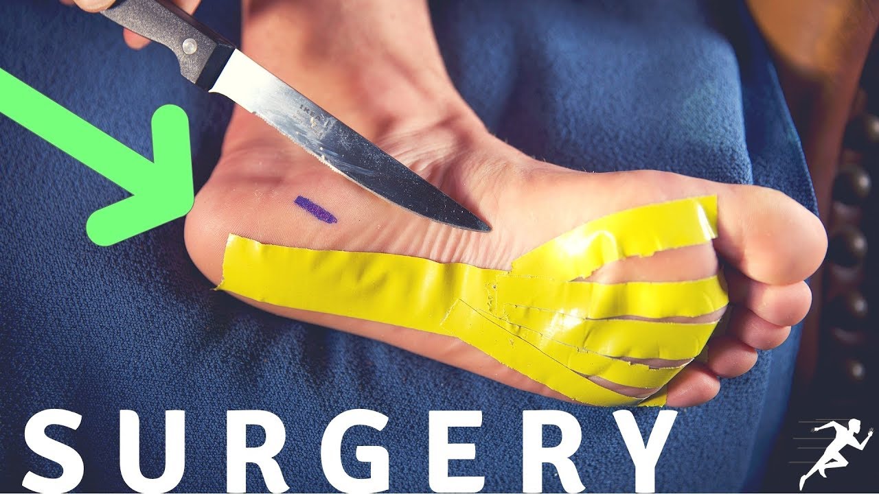 Plantar Fasciitis Surgery, a Runner’s Story