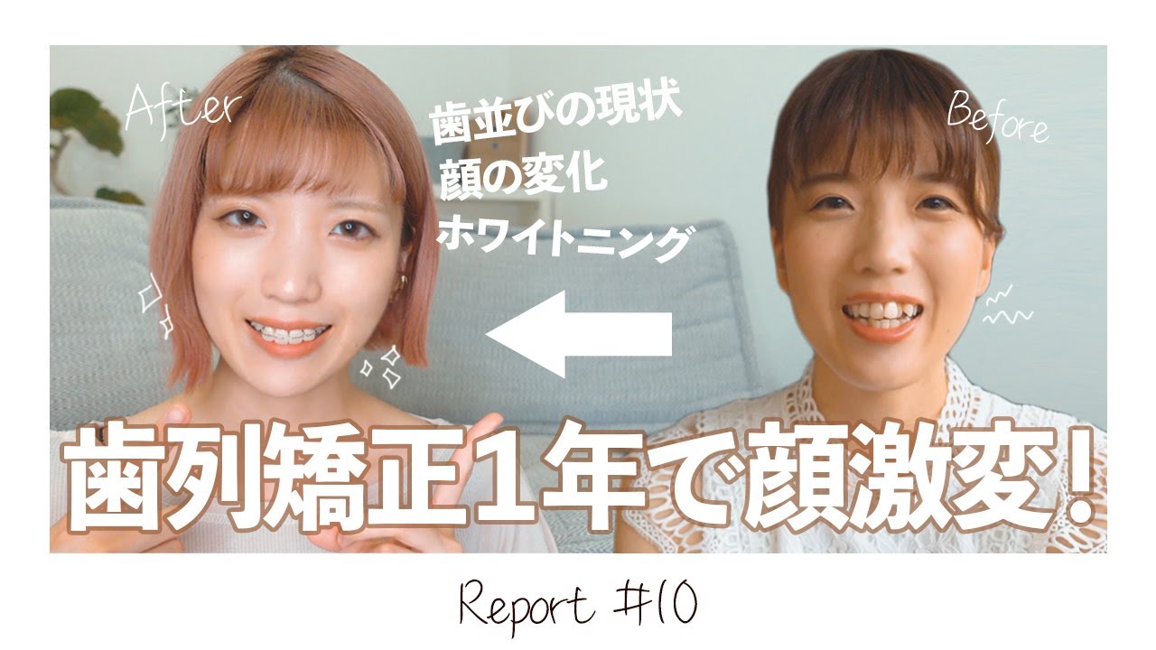 【歯列矯正】ついに１年経過！歯並び・顔の変化・矯正中のホワイトニング事情【表側ワイヤー矯正】