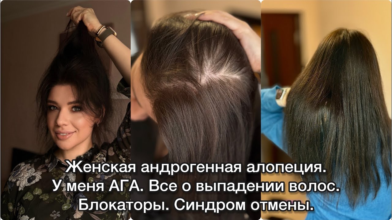 БЛОКАТОРЫ ПРИ АЛОПЕЦИИ. ВЫПАДЕНИЕ ВОЛОС. ОТ ЧЕГО ВЫПАДАЮТ ВОЛОСЫ? АГА. ВИБРОЗ. ДИФФУЗНОЕ ВЫПАДЕНИЕ 