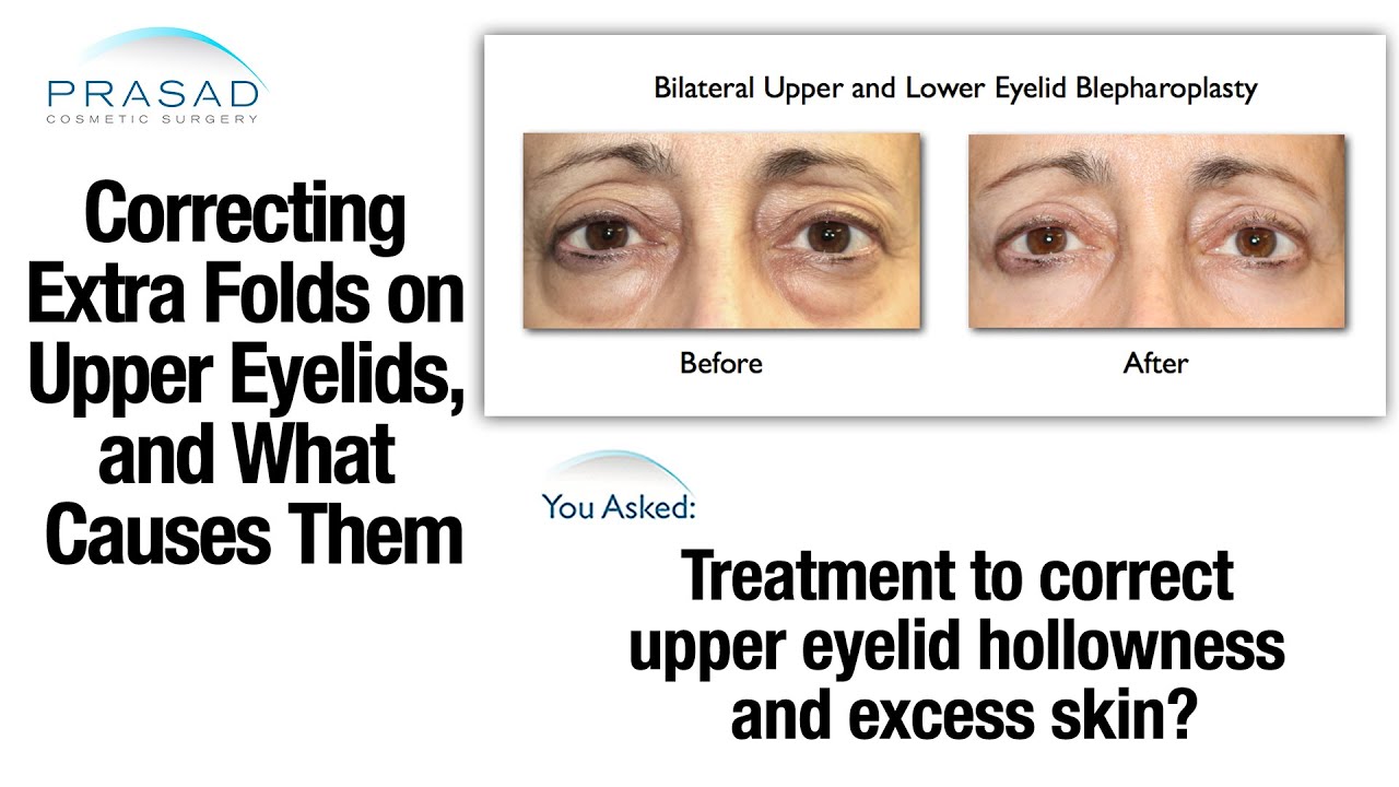 Possible Surgical Procedures to Address Multiple Folds on the Upper Eyelids